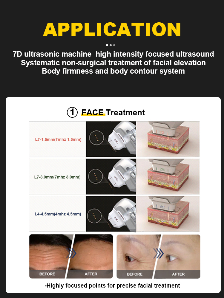 The 7D HIFU machine is a non-invasive beauty device that can provide local or comprehensive facial care using High Intensity Focused Ultraso (3)